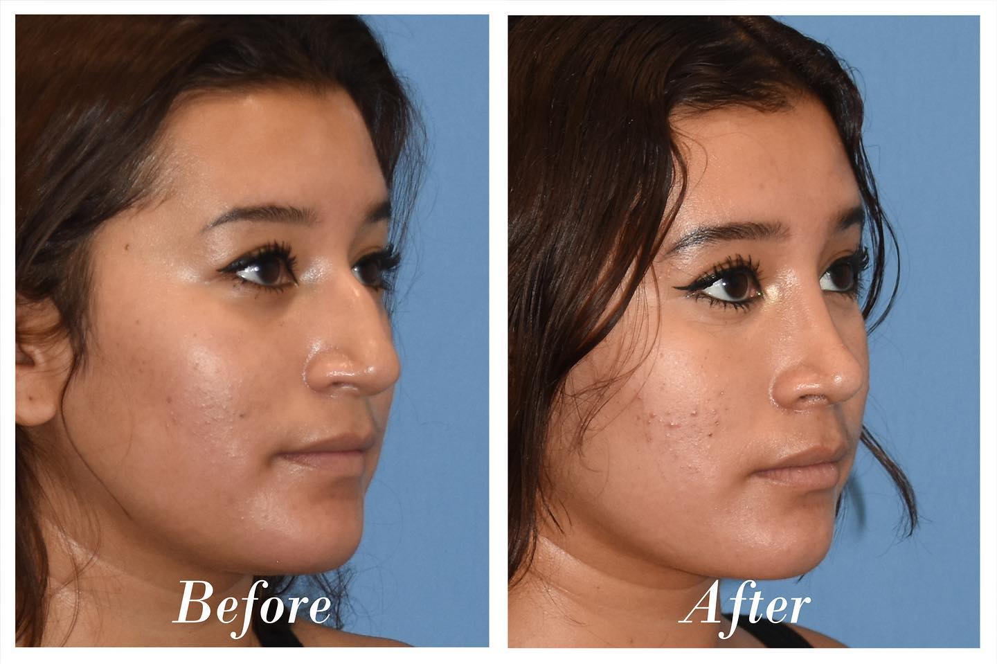 Rhinoplasty Before & After Image