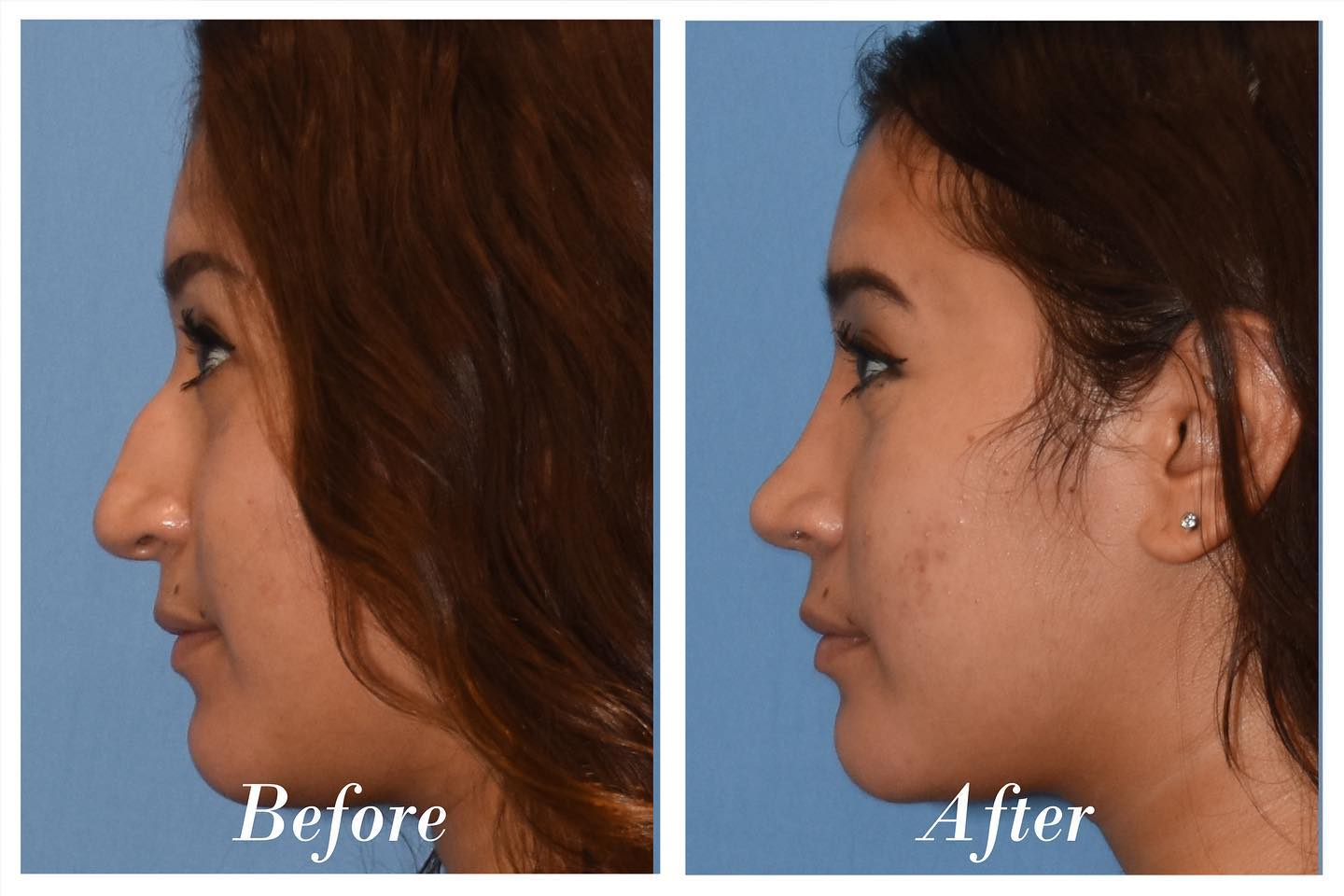 Rhinoplasty Before & After Image