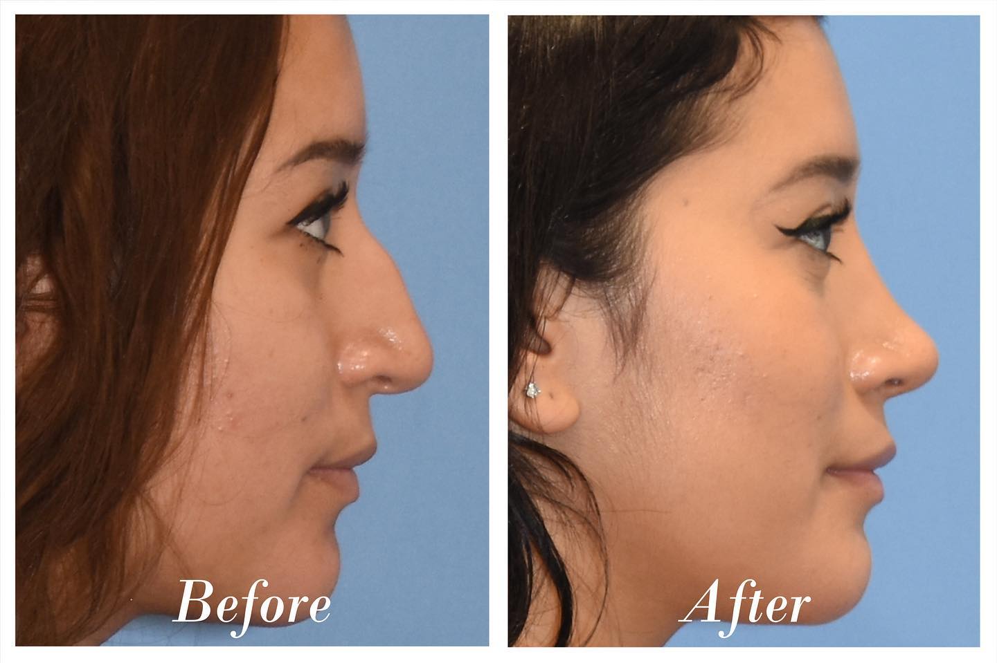 Rhinoplasty Before & After Image