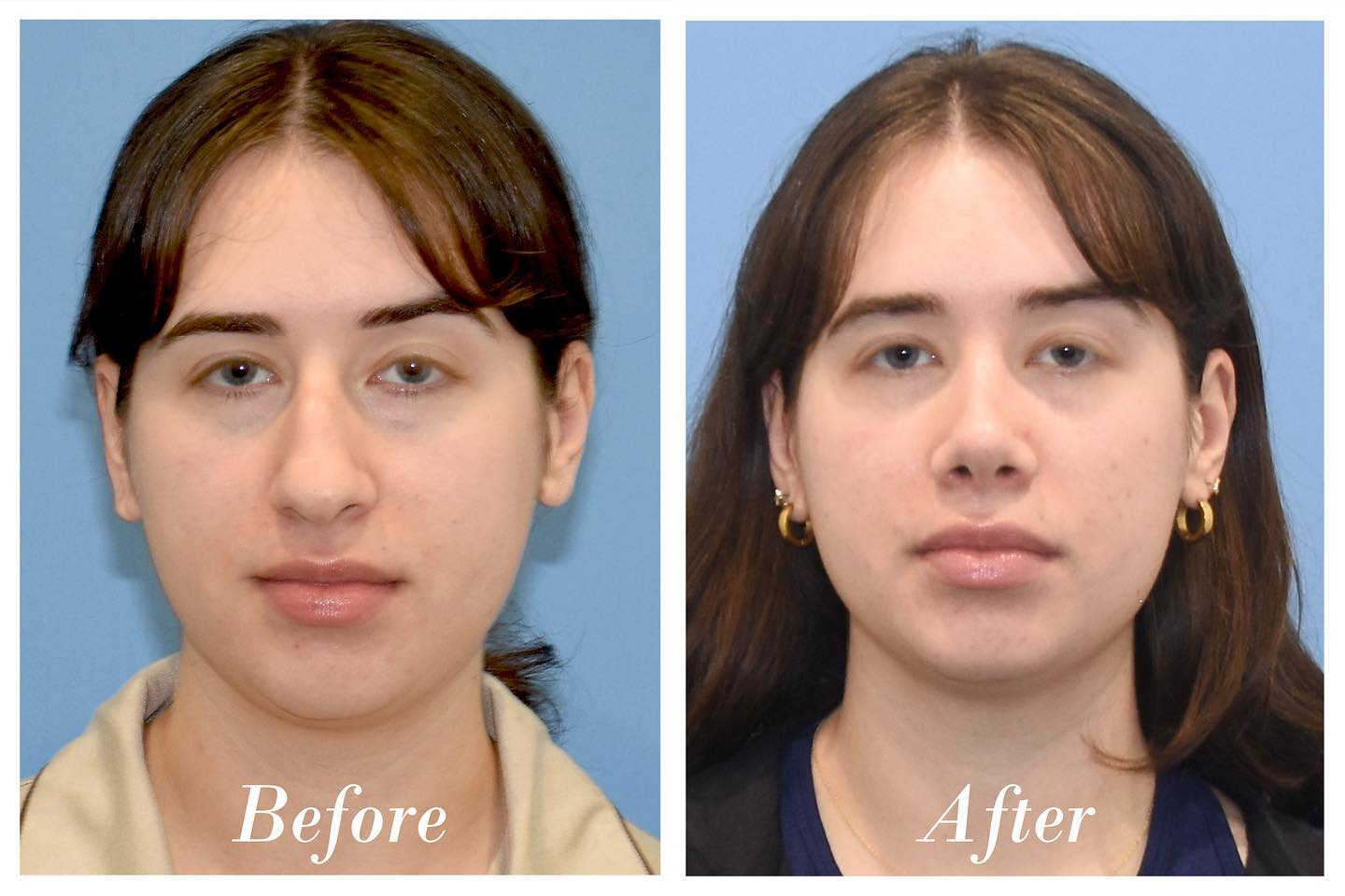 Rhinoplasty Before & After Image