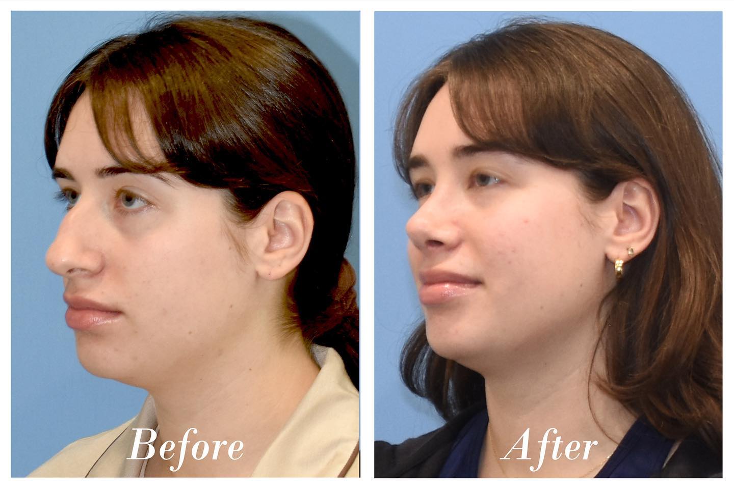 Rhinoplasty Before & After Image