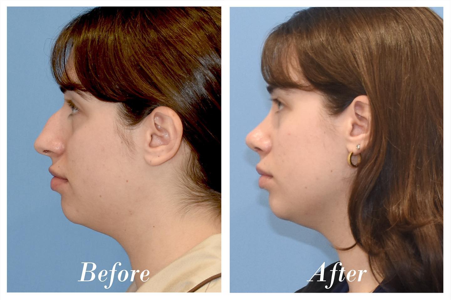 Rhinoplasty Before & After Image