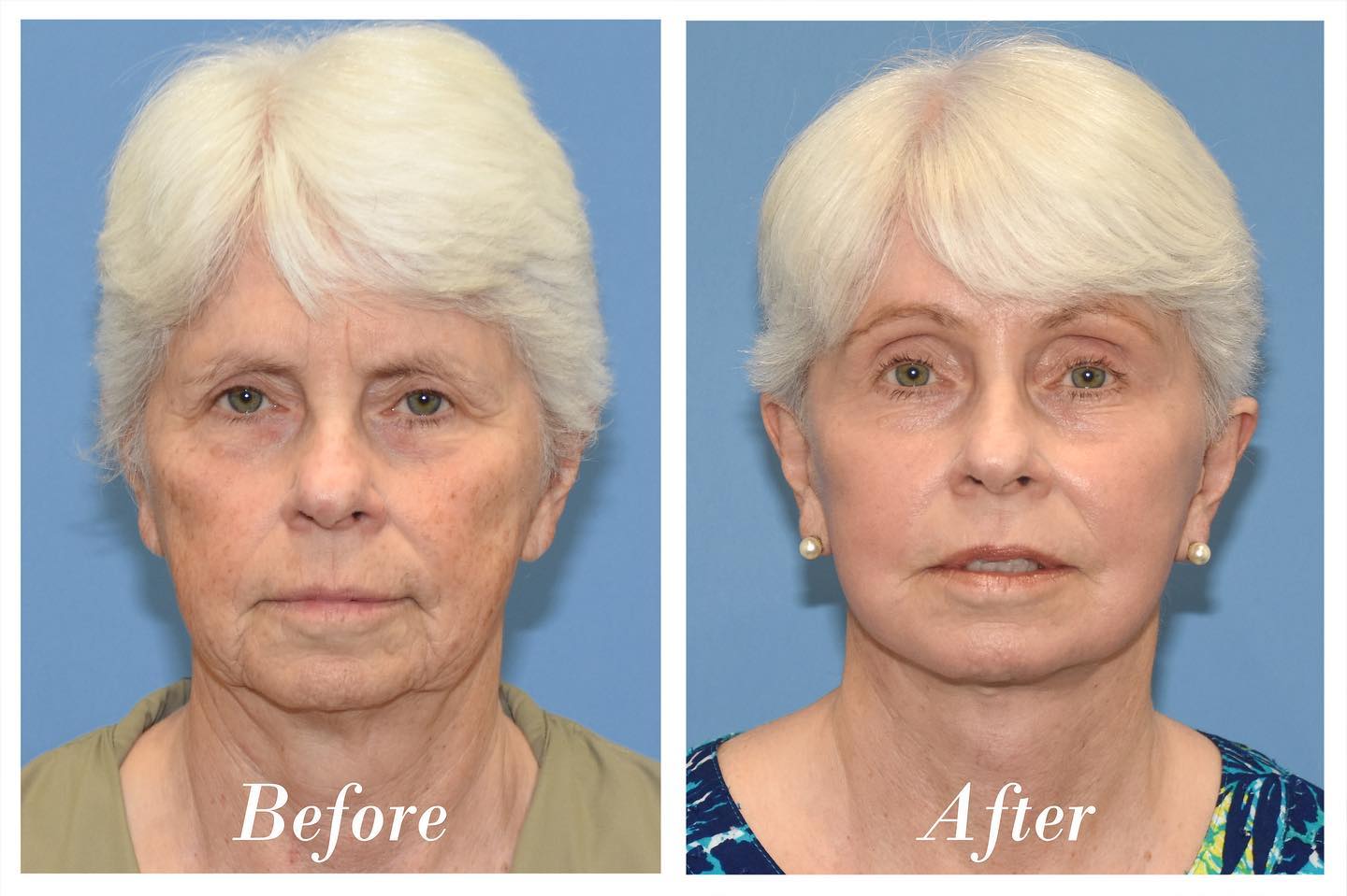 C02 Laser Skin Resurfacing Before & After Image