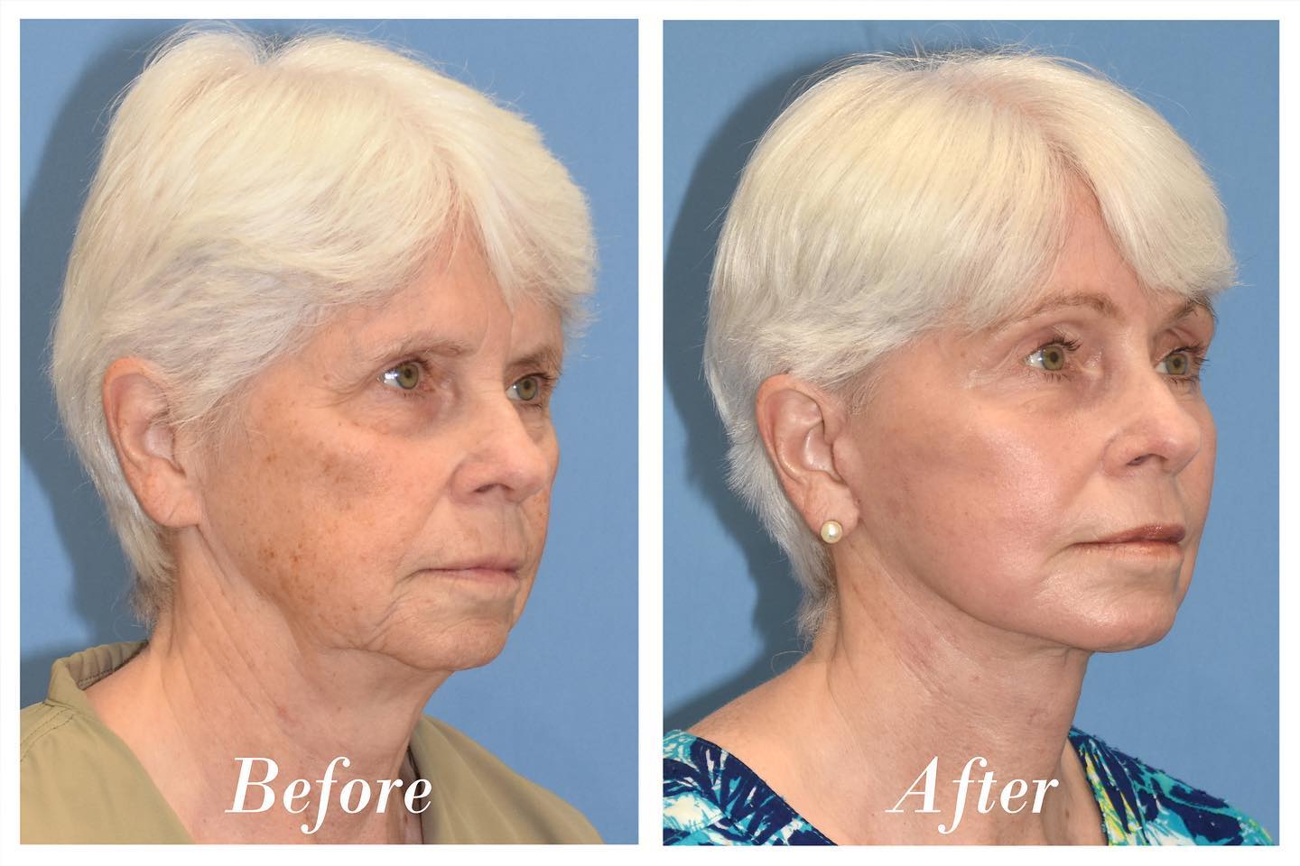 C02 Laser Skin Resurfacing Before & After Image