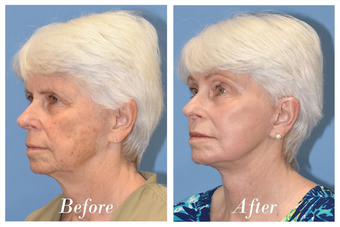 C02 Laser Skin Resurfacing Before & After Image