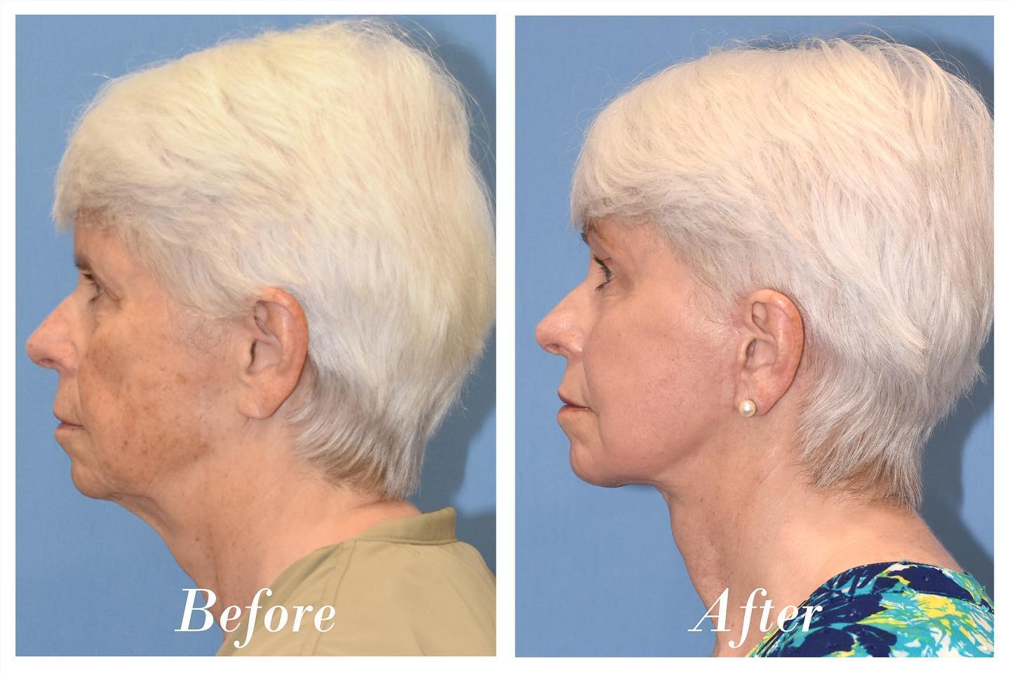 Facelift Browlift C02 Laser Skin Resurfacing Before & After Image