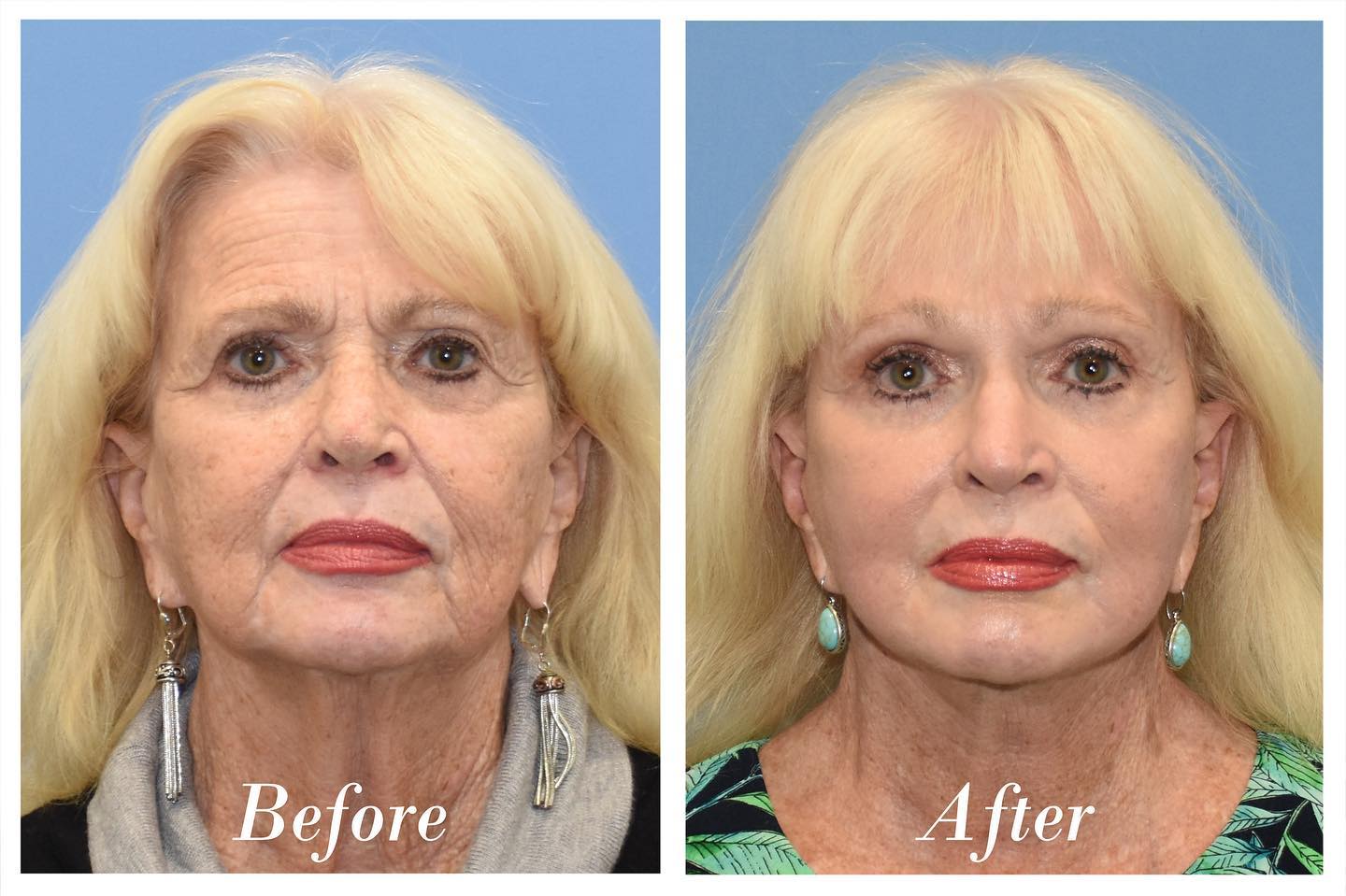 C02 Laser Skin Resurfacing Before & After Image