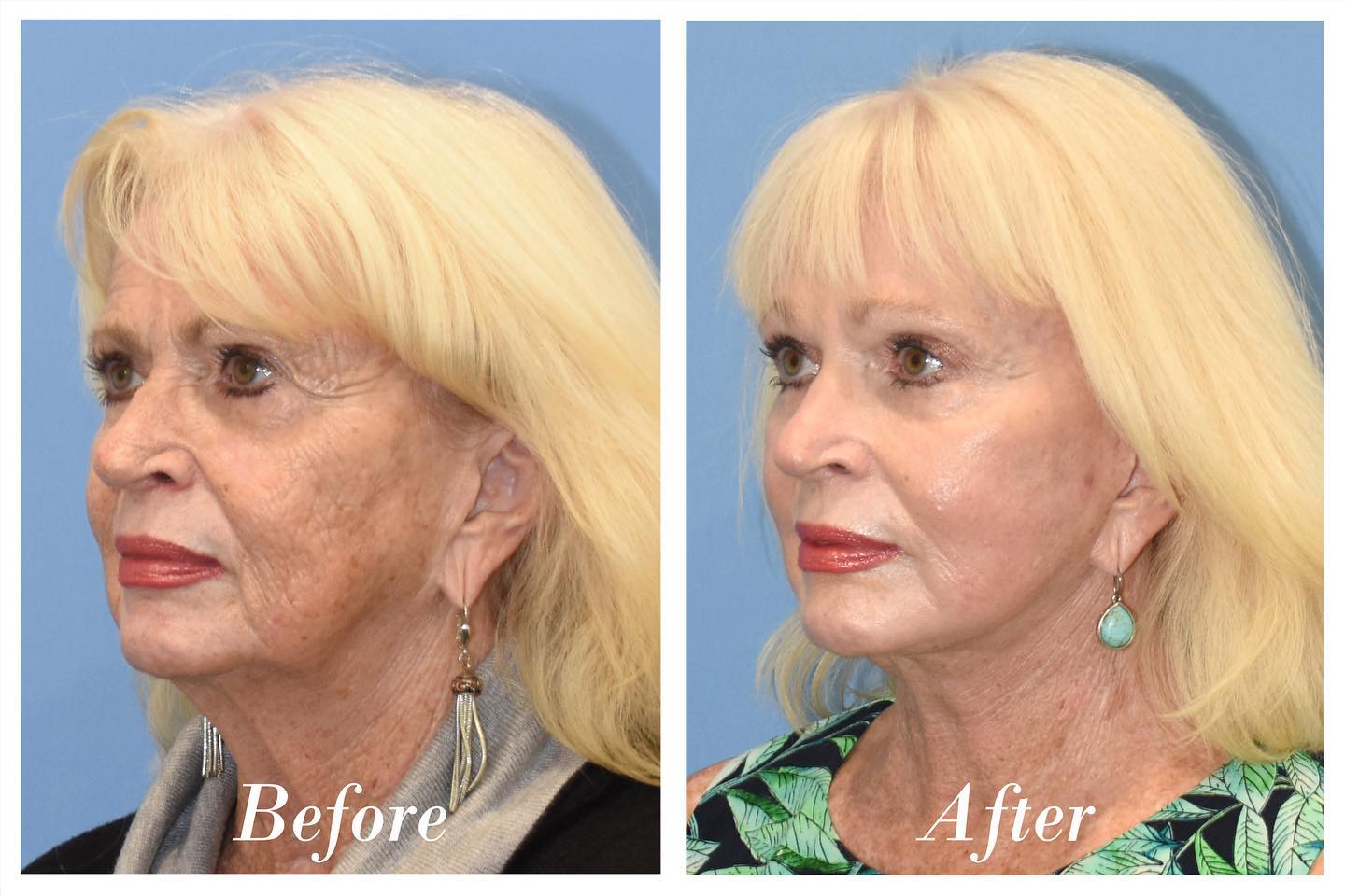 C02 Laser Skin Resurfacing Before & After Image