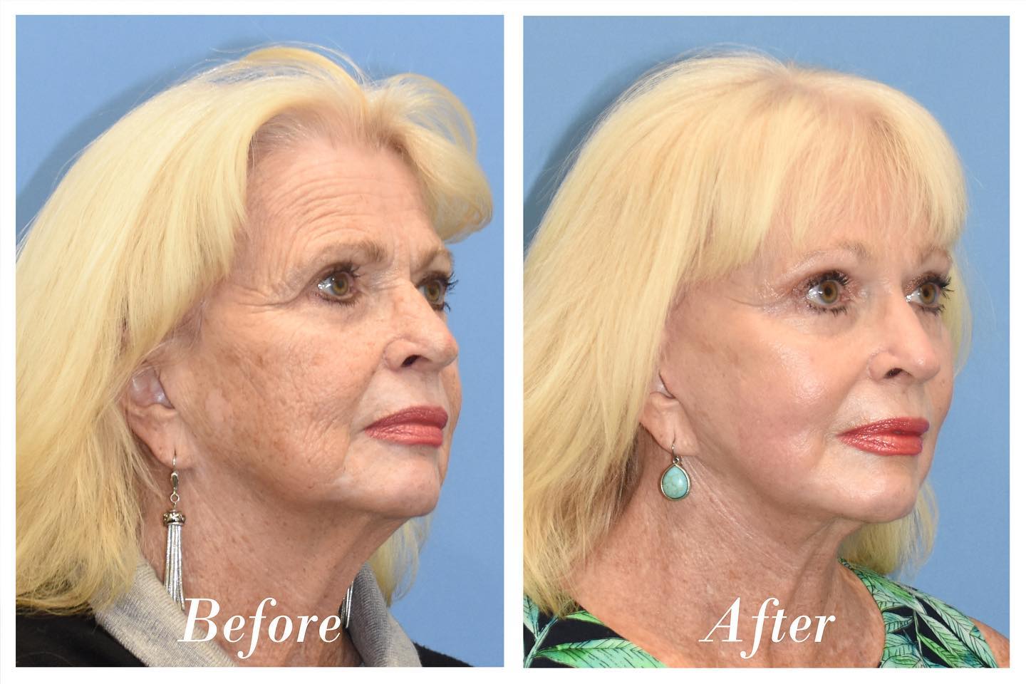 C02 Laser Skin Resurfacing Before & After Image