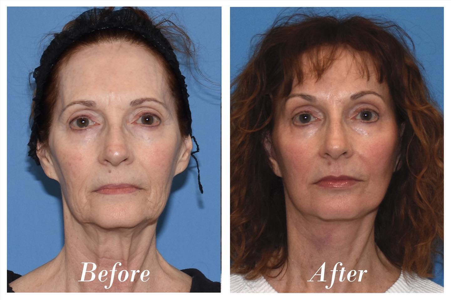 C02 Laser Skin Resurfacing Before & After Image