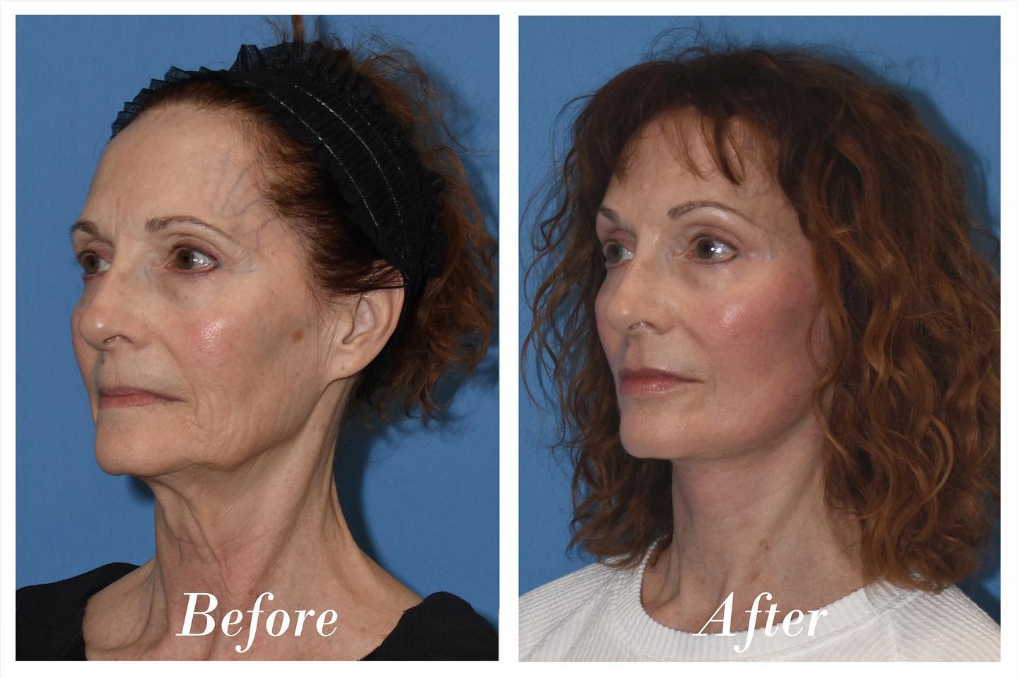 C02 Laser Skin Resurfacing Before & After Image