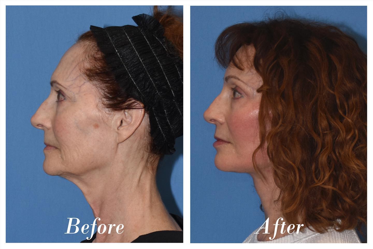 Facelift Browlift C02 Laser Skin Resurfacing Before & After Image