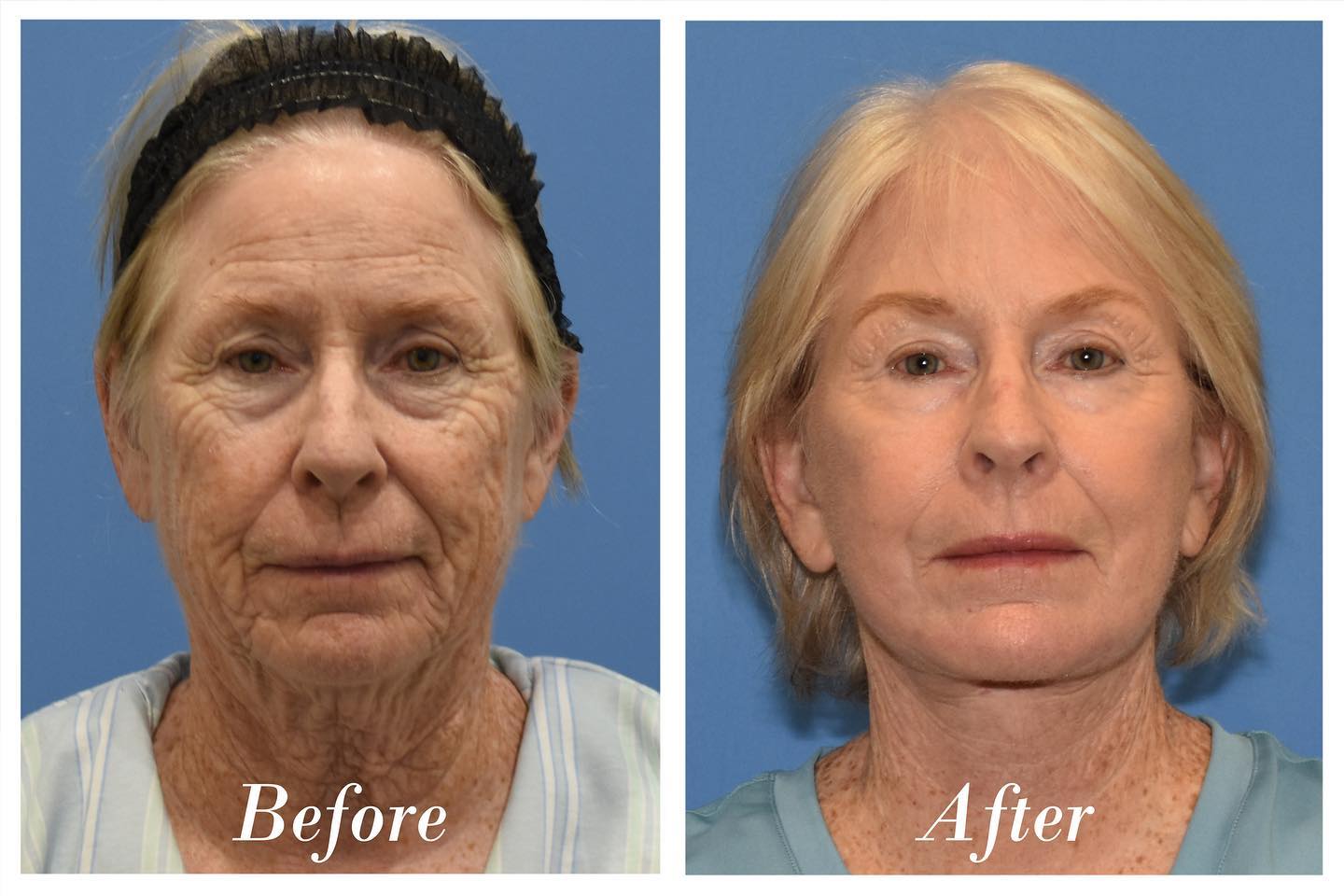 C02 Laser Skin Resurfacing Before & After Image
