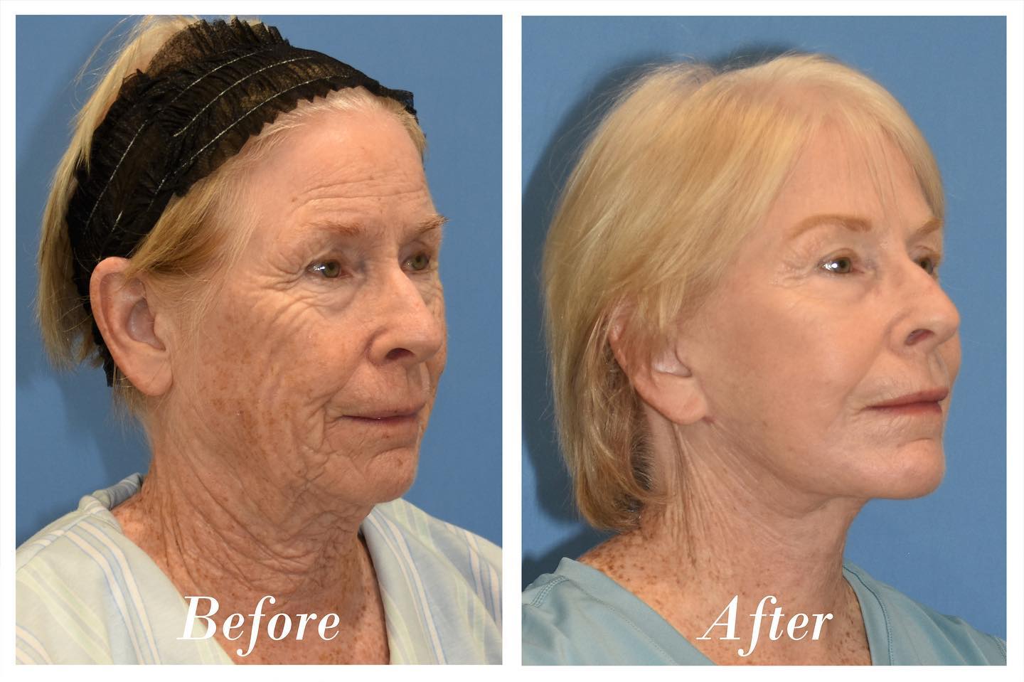 C02 Laser Skin Resurfacing Before & After Image