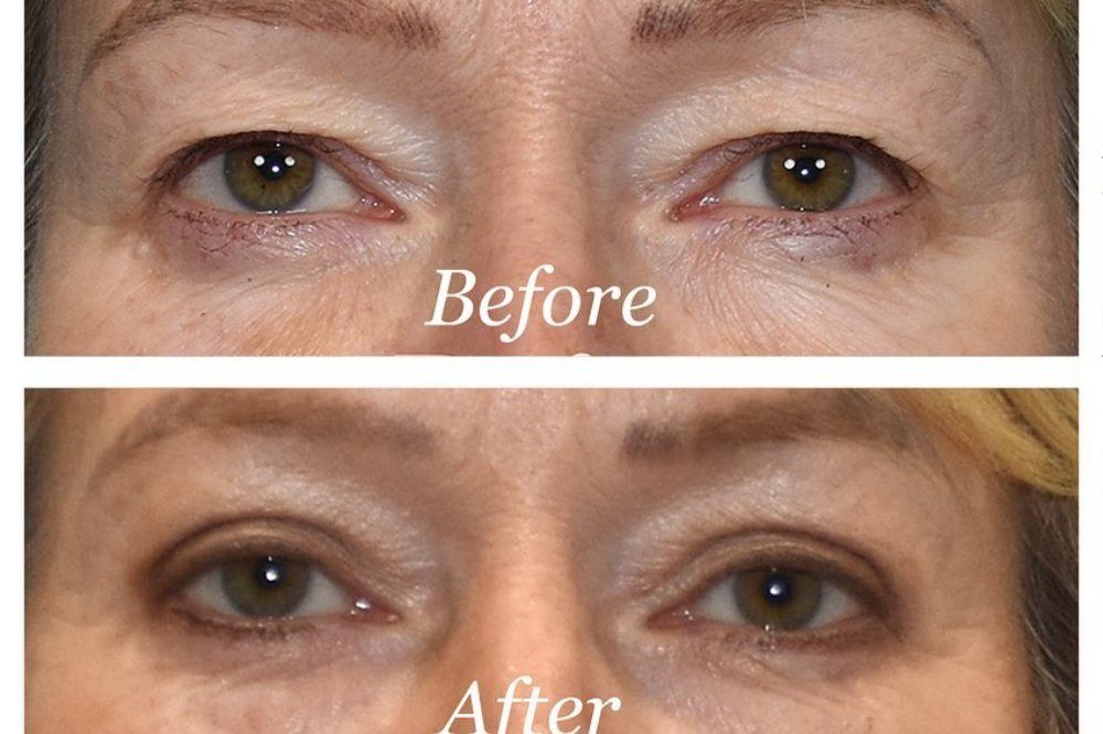 Upper Blepharoplasty Before & After Image