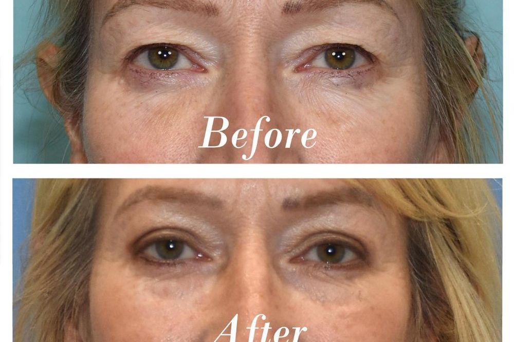 Upper Blepharoplasty Before & After Image