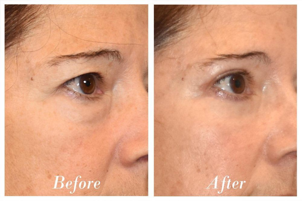 Upper Blepharoplasty Before & After Image