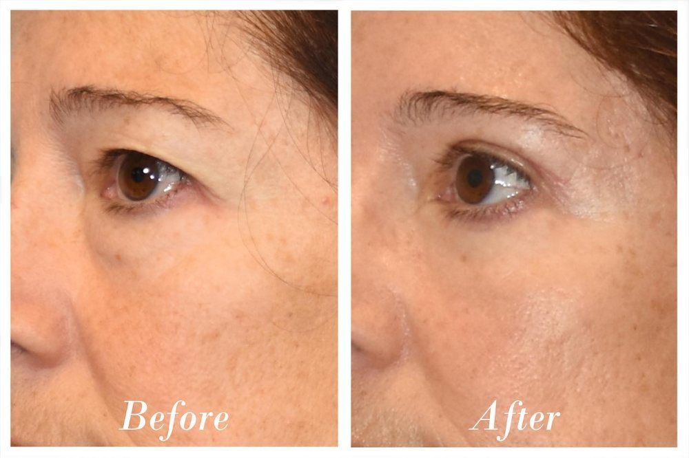 Upper Blepharoplasty Before & After Image