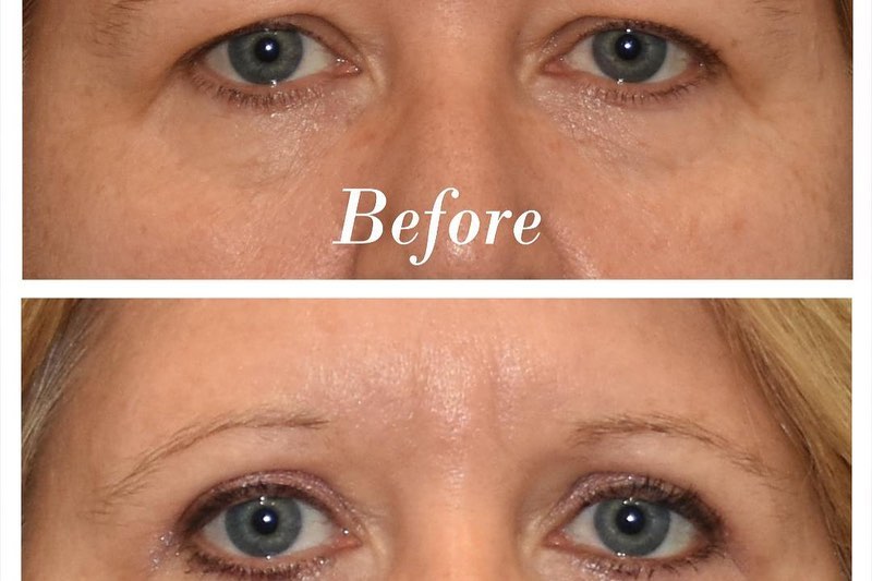 Upper Blepharoplasty Before & After Image