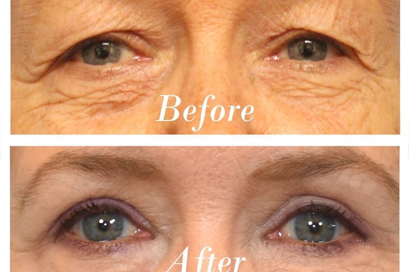 Upper Blepharoplasty Before & After Image