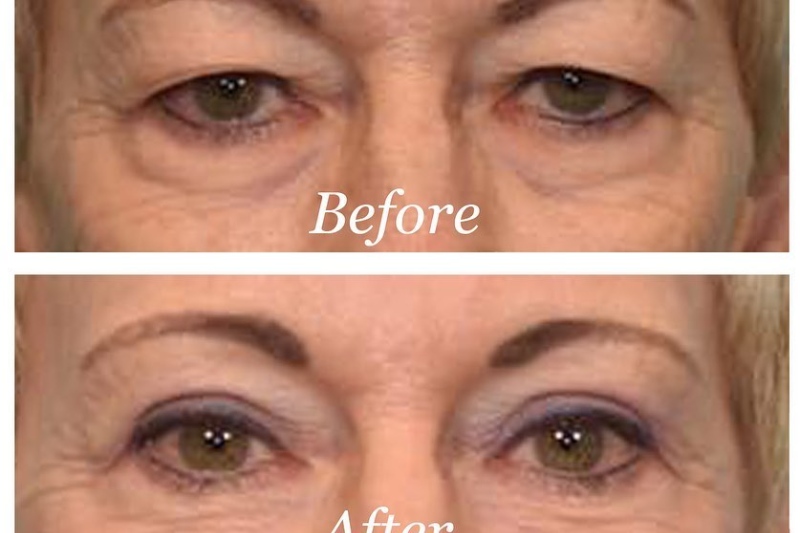 Upper Blepharoplasty Before & After Image