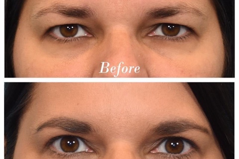 Upper Blepharoplasty Before & After Image