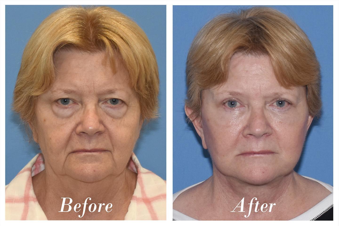 Blepharoplasty Before & After Image