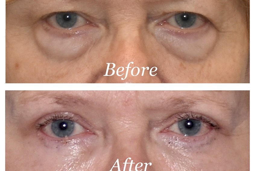 Blepharoplasty Before & After Image