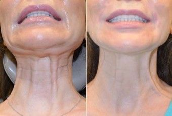 Botox Before & After Image