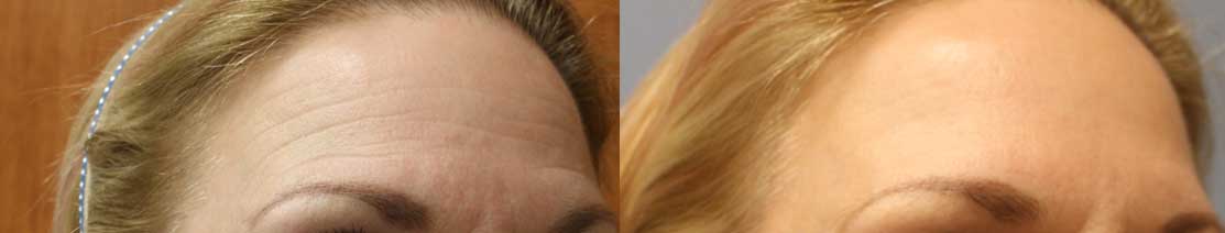 Botox Before & After Image