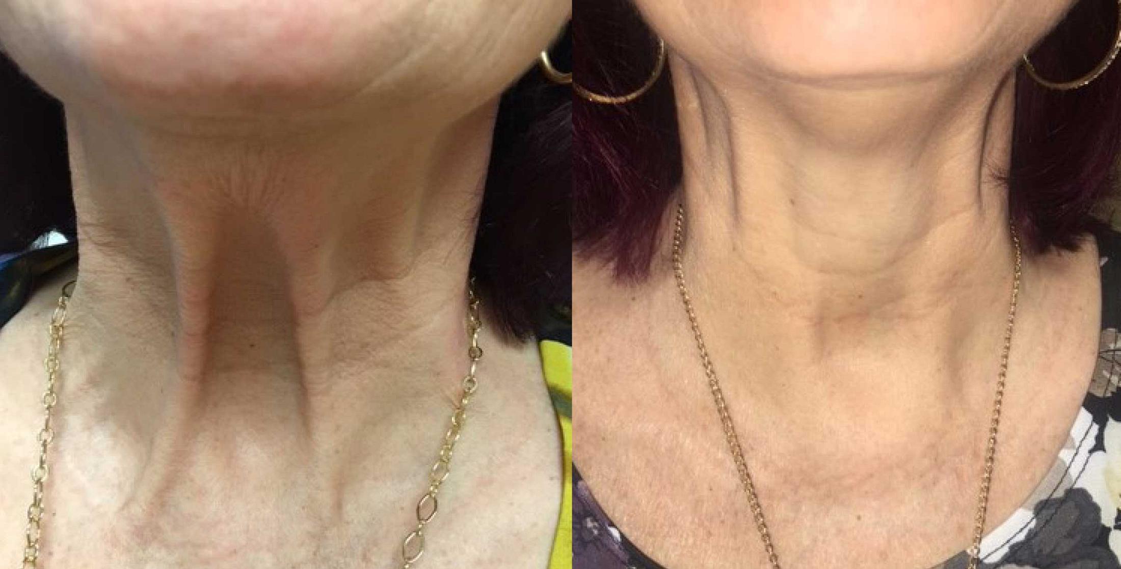 Botox Before & After Image