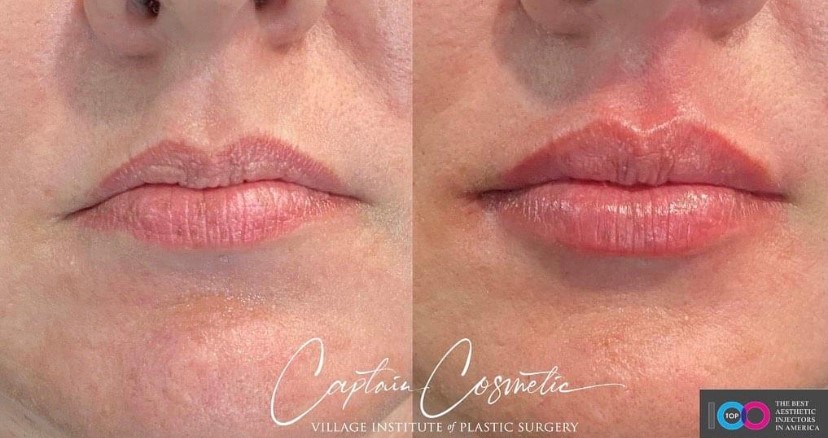 Lip Fillers Before & After Image