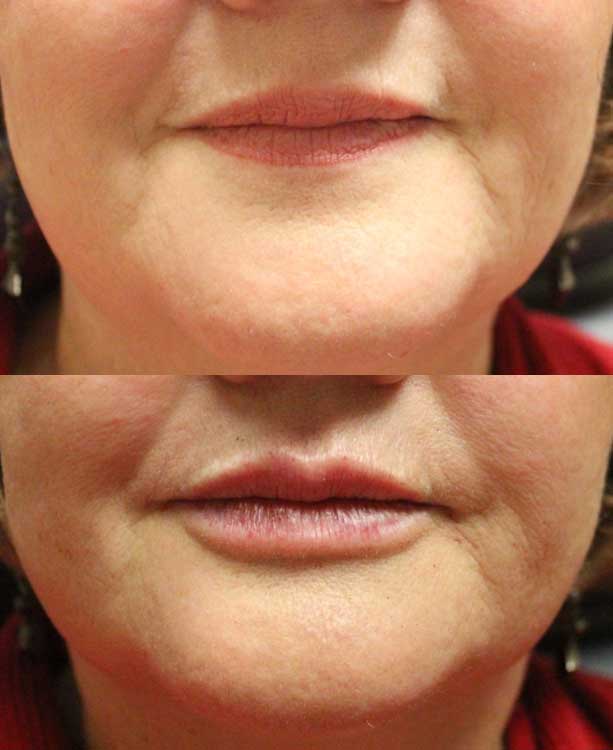 Lip Fillers Before & After Image