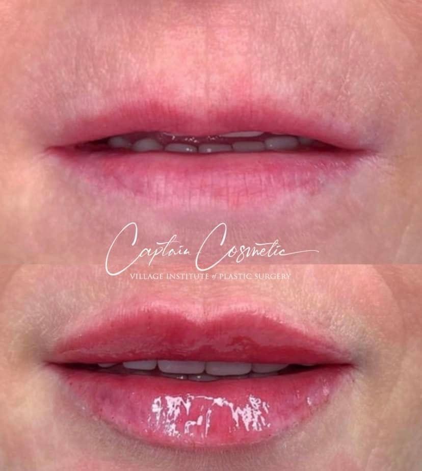 Lip Fillers Before & After Image