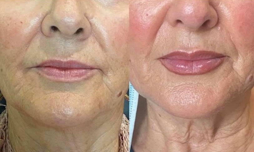 Lip Fillers Before & After Image