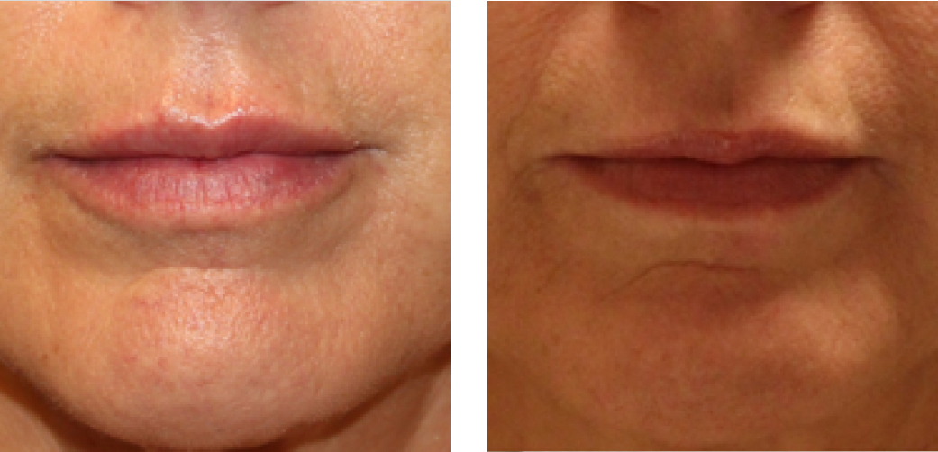 Lip Fillers Before & After Image