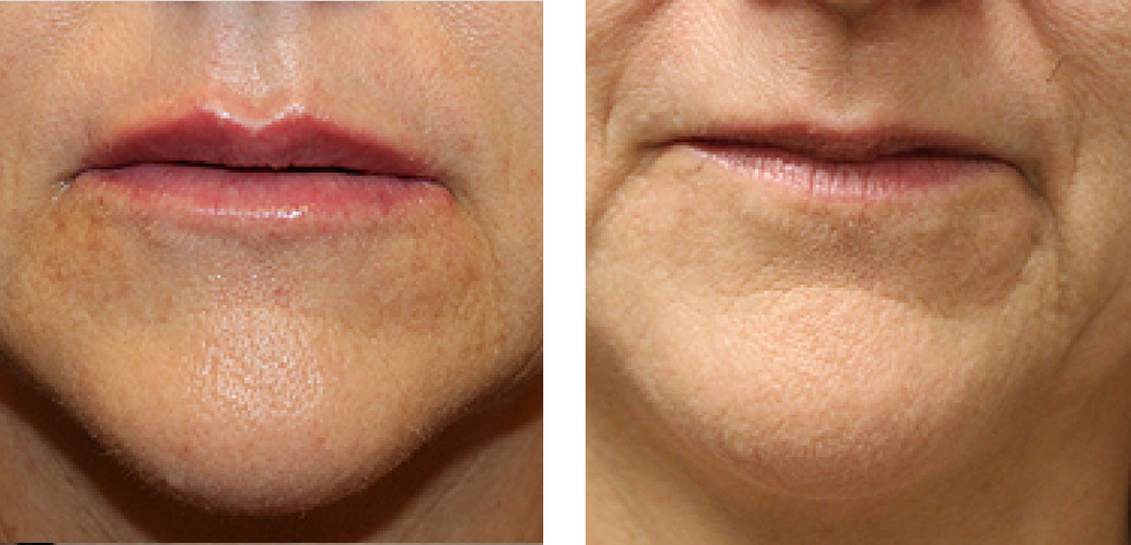 Lip Fillers Before & After Image