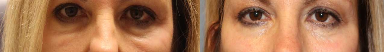 Lip Fillers Nasolabial Marionette Lines Before & After Image
