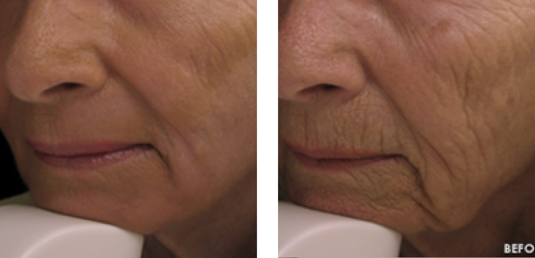 Laser Wrinkle Reduction Before & After Image