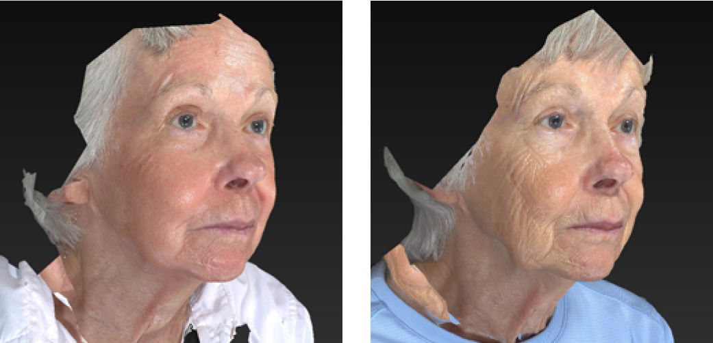 Laser Wrinkle Reduction Before & After Image