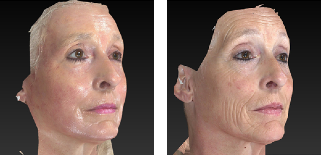 Laser Wrinkle Reduction Before & After Image