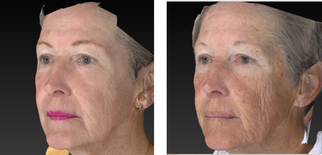 Laser Wrinkle Reduction Before & After Image