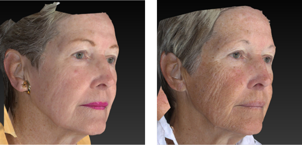 Laser Wrinkle Reduction Before & After Image