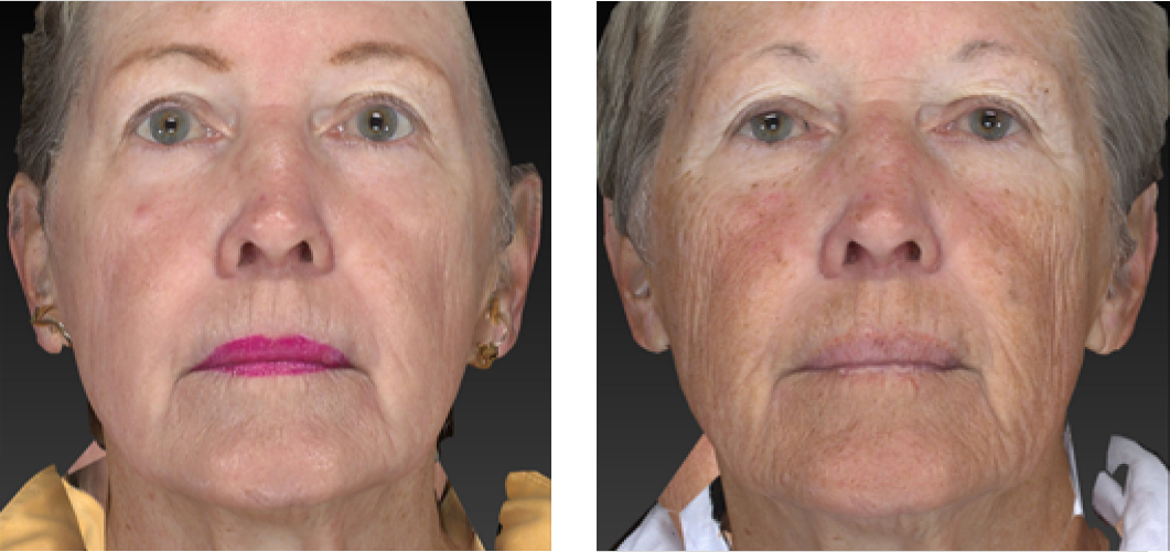 Laser Wrinkle Reduction Before & After Image