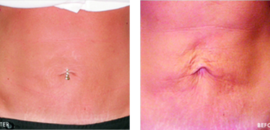 Thermal Wrinkle Reduction Before & After Image
