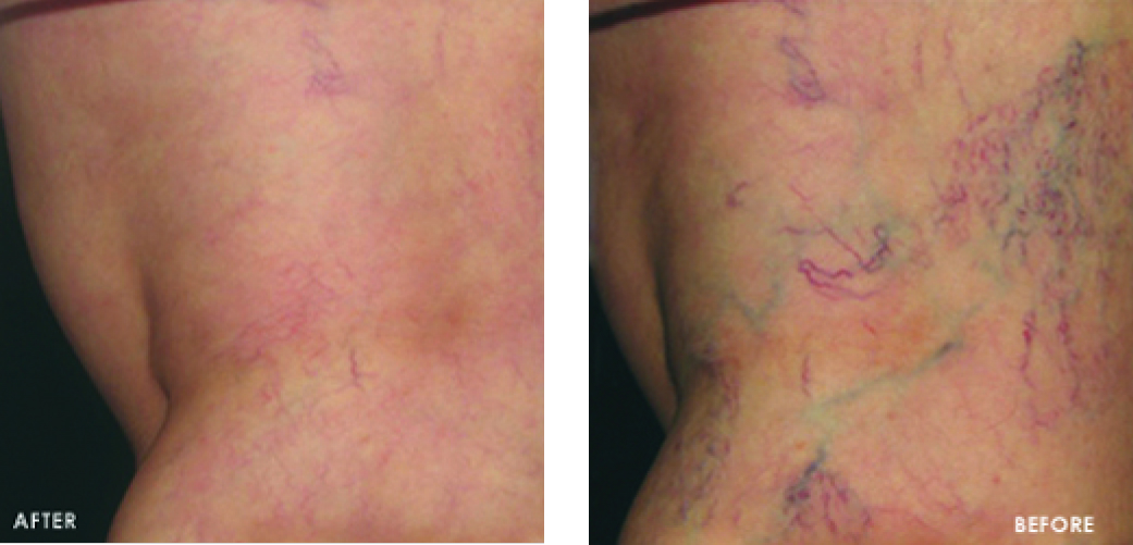 Varicose Vein Treatment Before & After Image